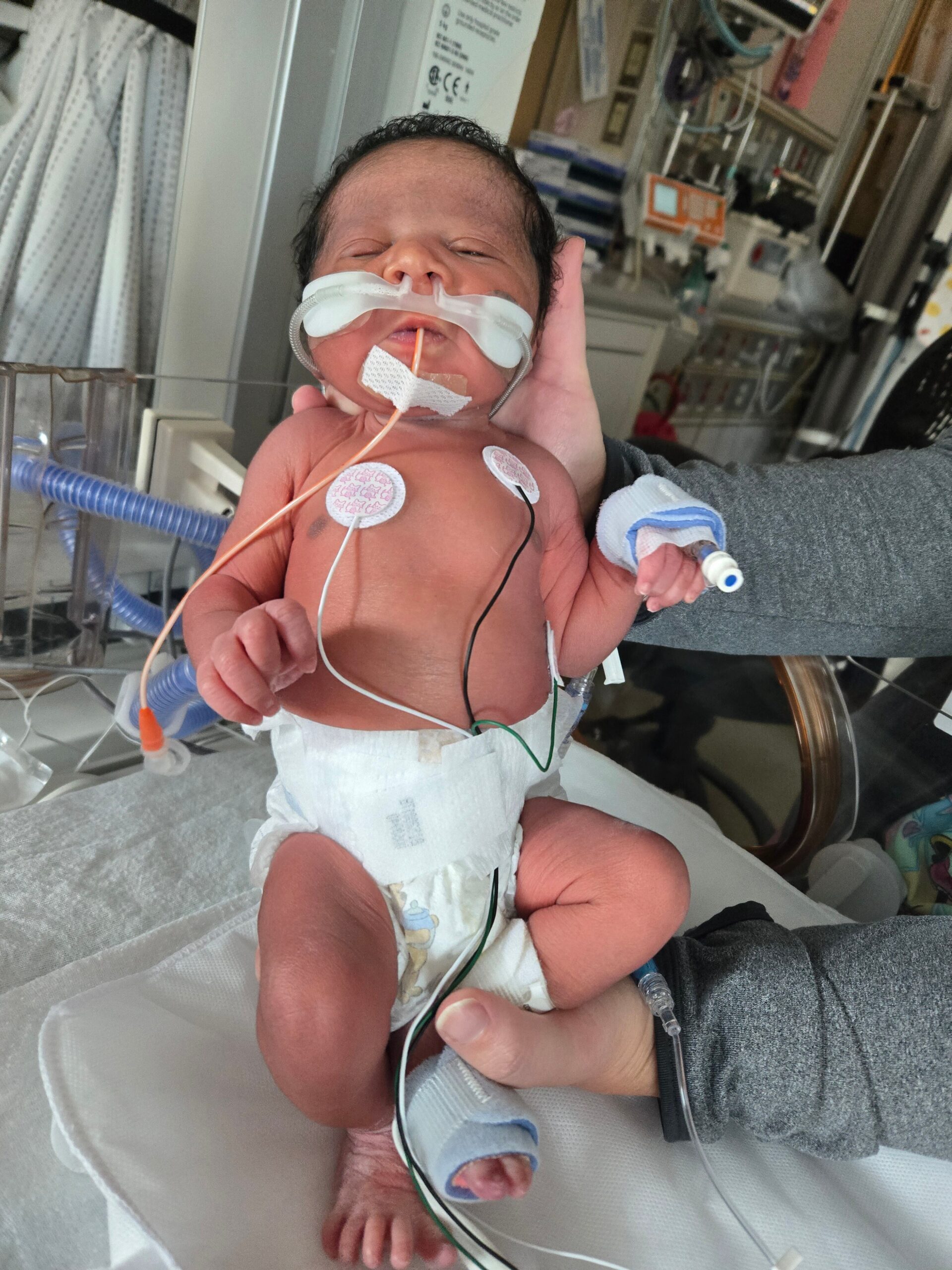 Newborn baby in a hospital neonatal unit with oxygen tubing over the face, held by an adult untilted chair, with monitoring electrodes on chest and leg.