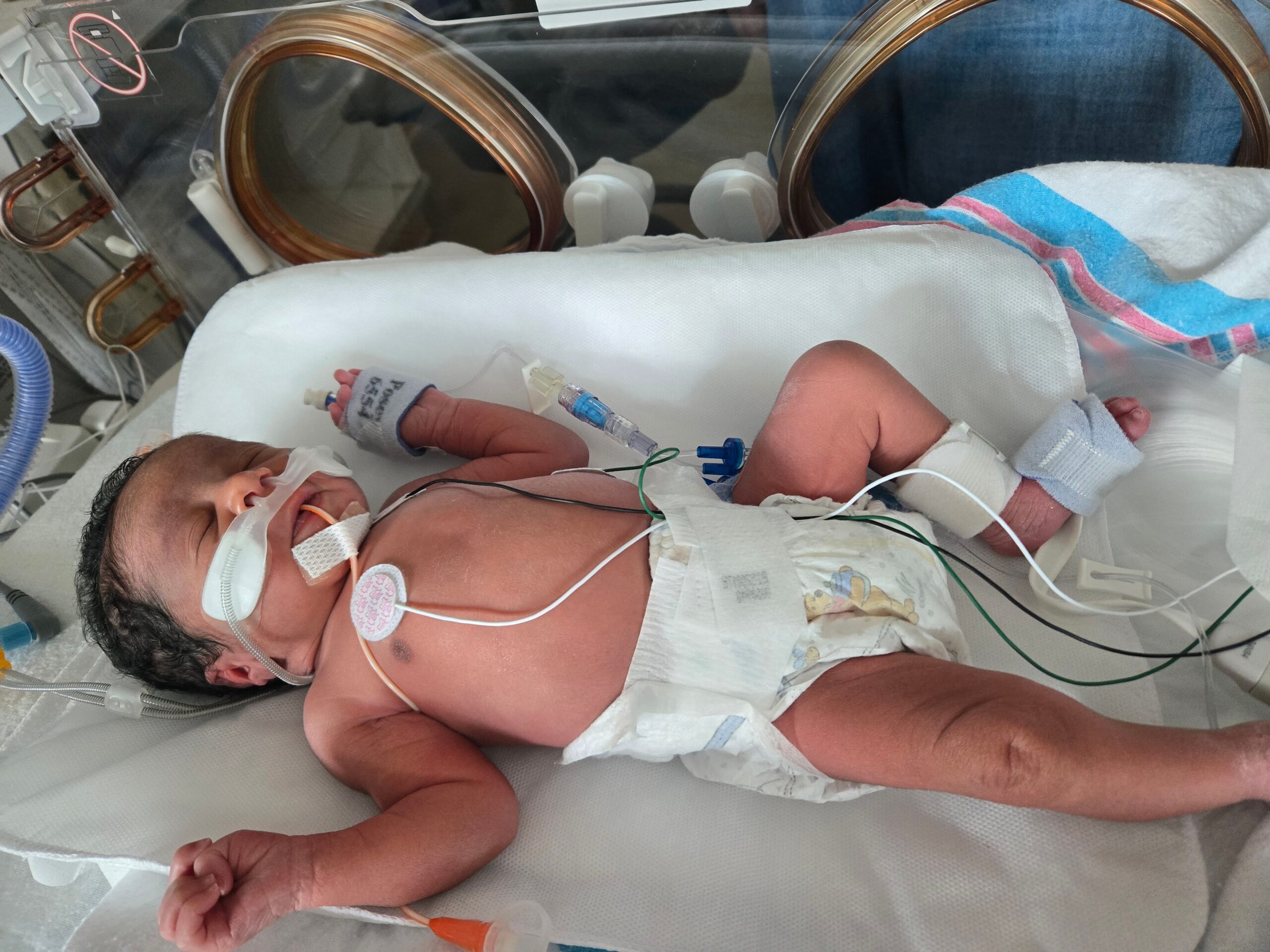 Newborn baby in a hospital incubator connected to tubes and monitors, resting on a white blanket