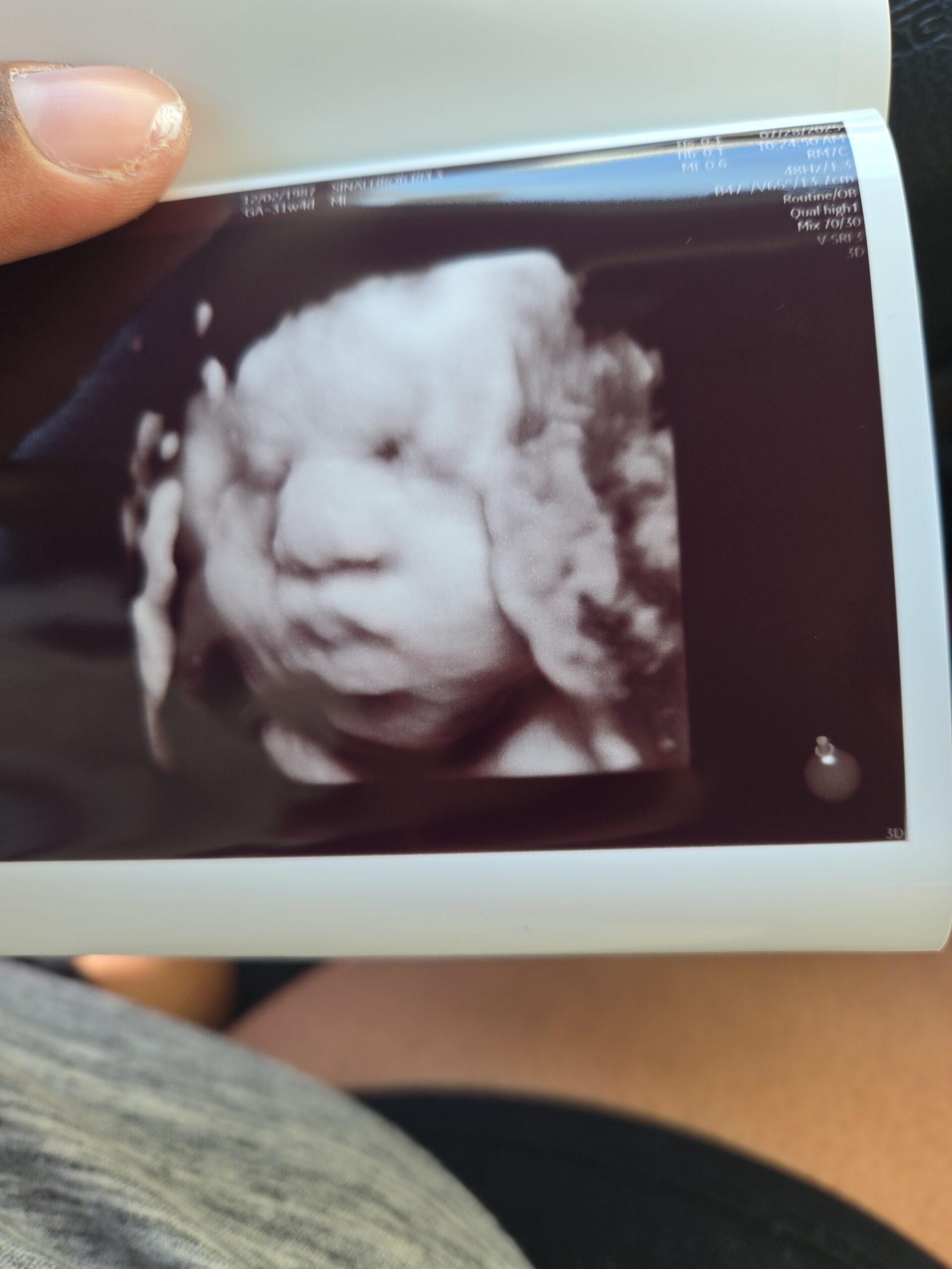3D ultrasound image of a fetus with facial features visible, held by a hand against a dark background